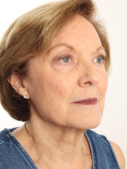 Blepharoplasty Before & After Patient #4665