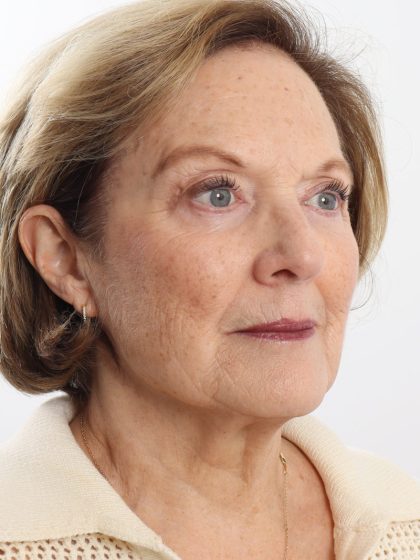 Blepharoplasty Before & After Patient #4665