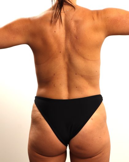 Liposuction Before & After Patient #4724