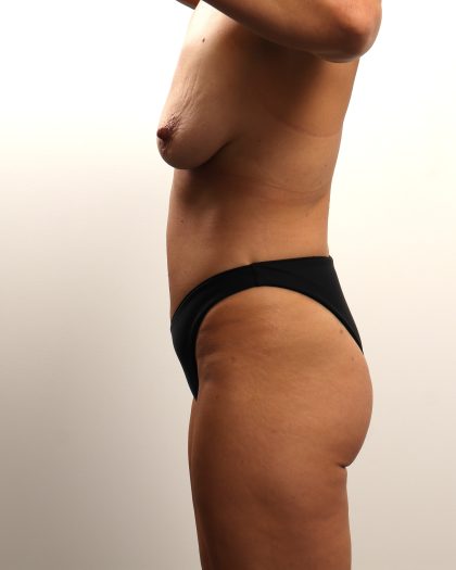 Liposuction Before & After Patient #4724