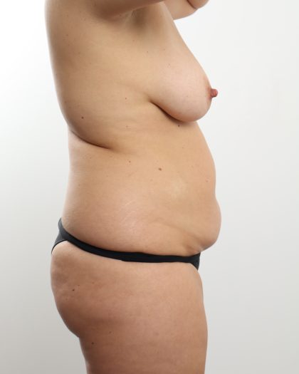 Liposuction Before & After Patient #4724
