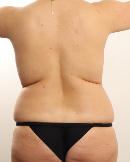Liposuction Before & After Patient #4724