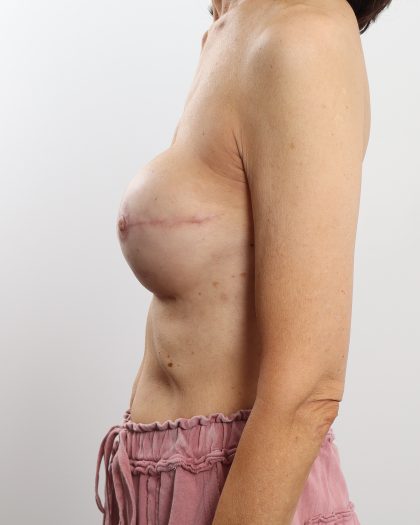 Breast Reconstruction Before & After Patient #4741