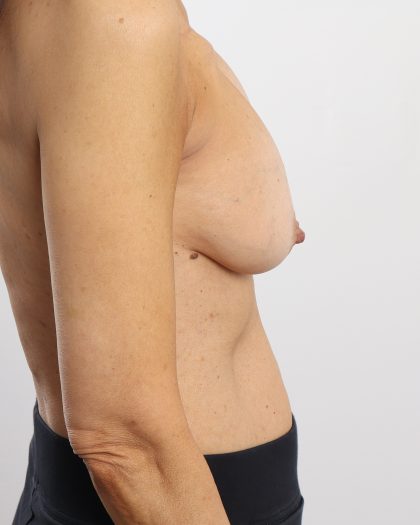 Breast Reconstruction Before & After Patient #4741
