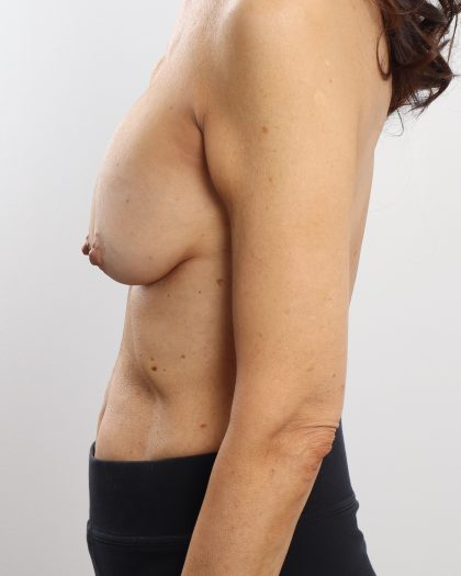 Breast Reconstruction Before & After Patient #4741
